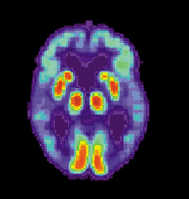 Hirnscan eines Alzheimer-Patienten (Photo credit: Public Domain: US National Institute on Aging, Alzheimer's Disease Education and Referral Center/Wikipedia)
